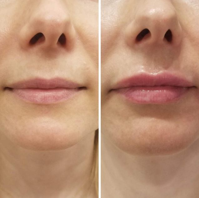 Lip Flip Botox