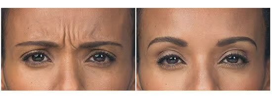 Glabella Lines Botox