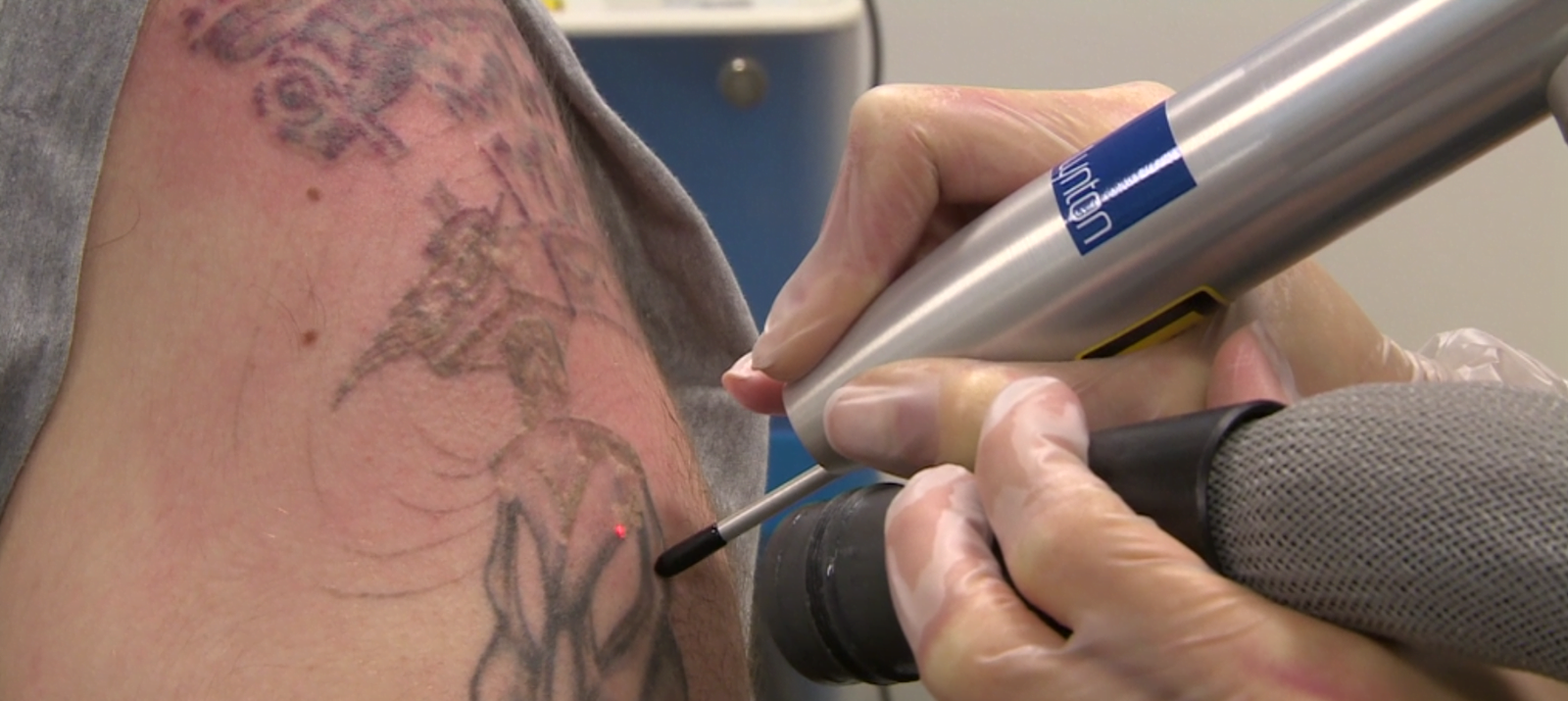 Extra Small Tattoo Removal