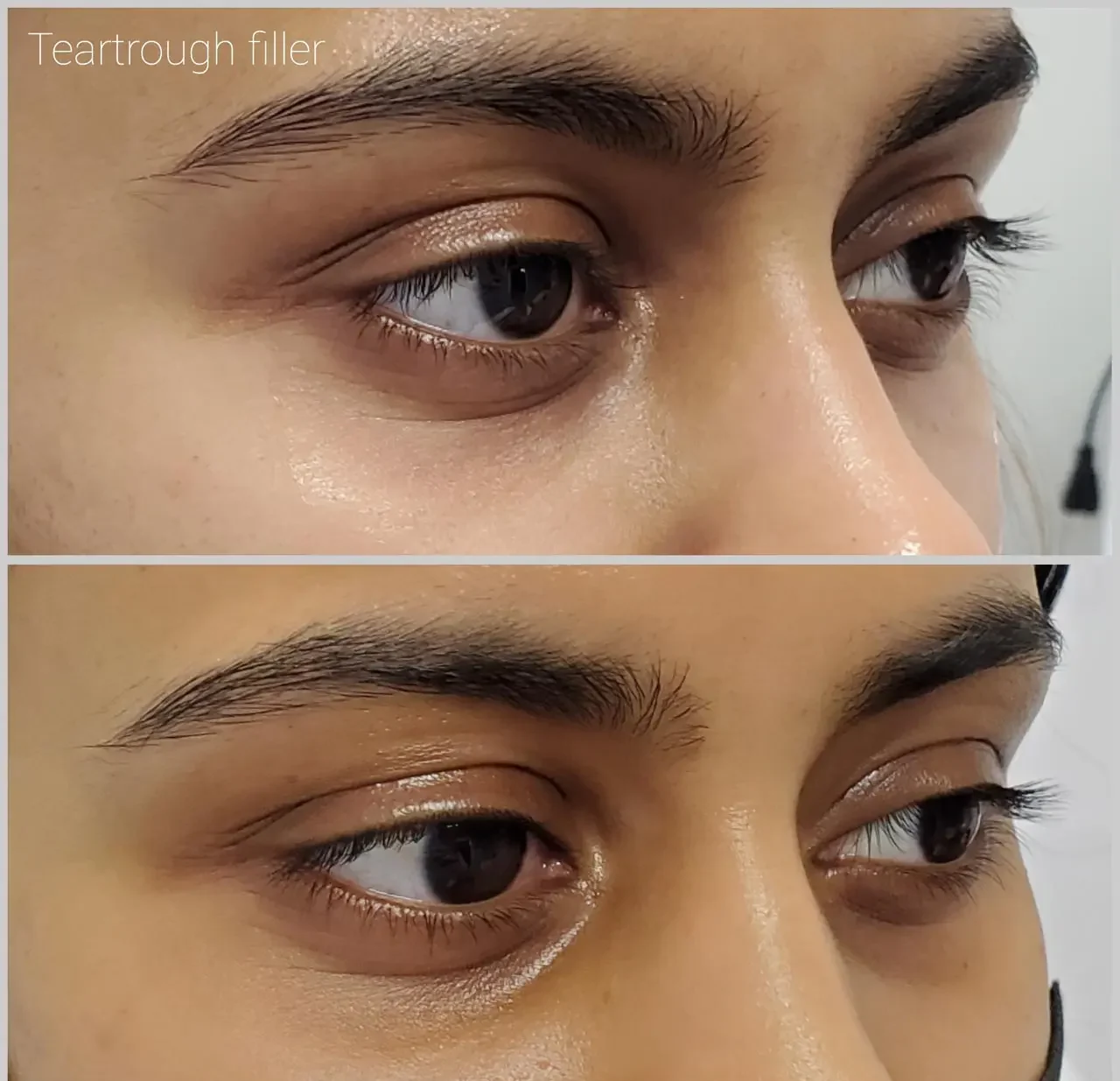 PRF Under-Eyes
