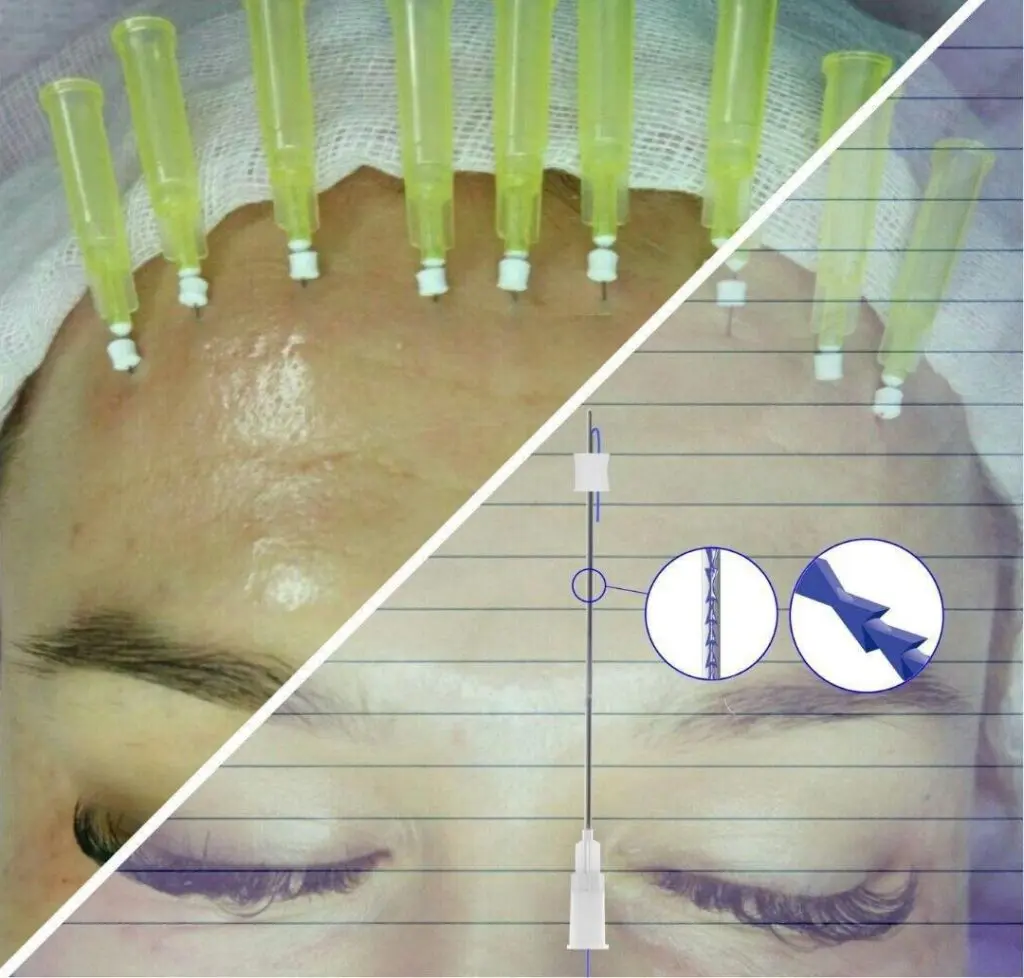 Forehead Eyebrow PDO