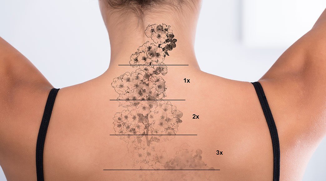 X-Large Tattoo Removal