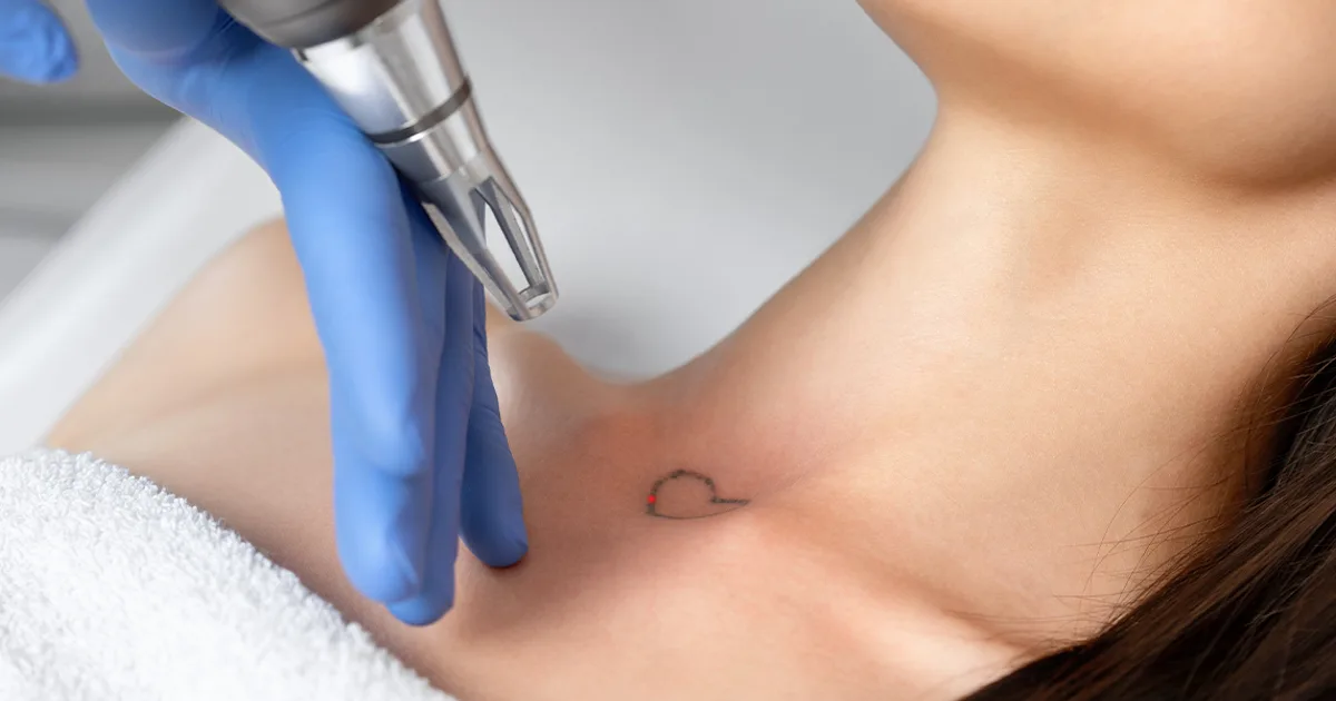 Medium Tattoo Removal