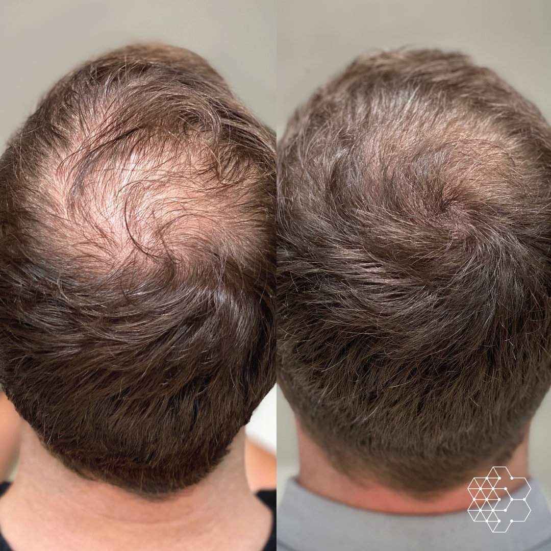 PRP Hair Restoration