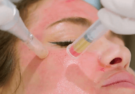 Microneedling with PRP