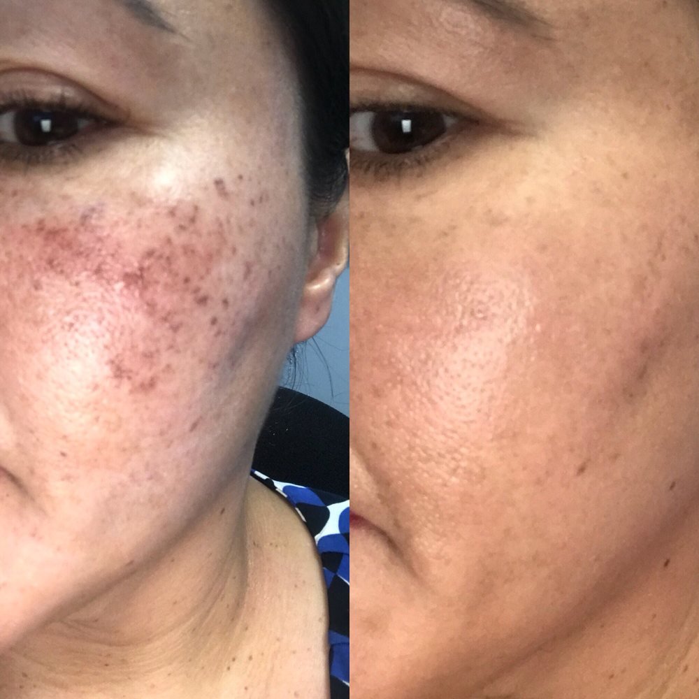 PRP Acne Scars