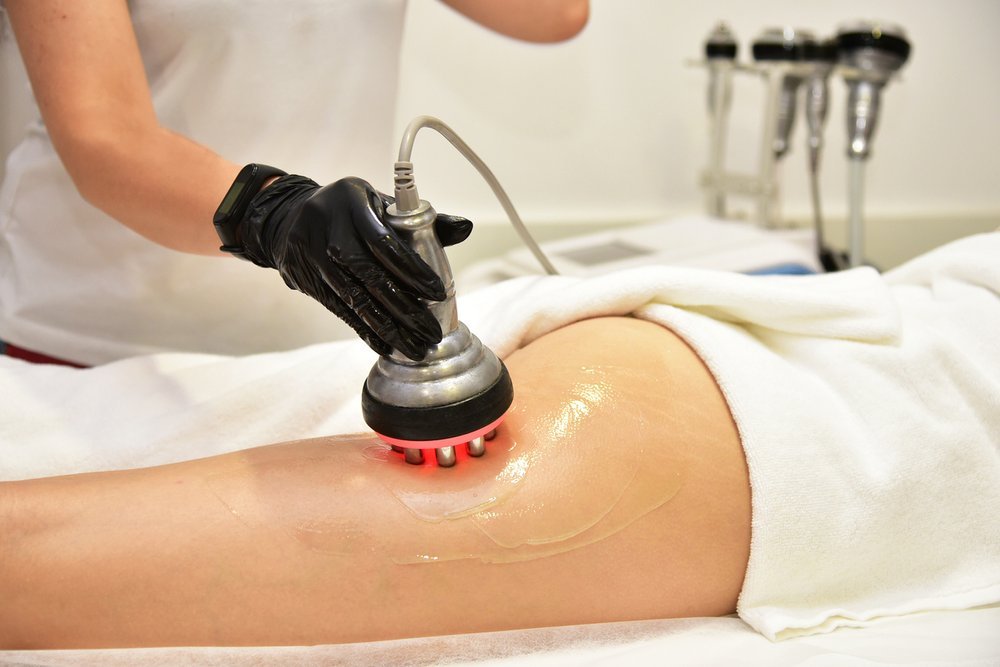 Laser Lipo