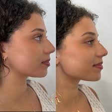 PRF Jawline and Chin