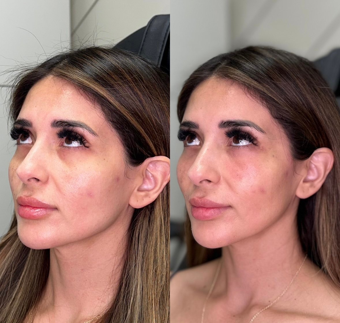 PRF Nasolabial Folds