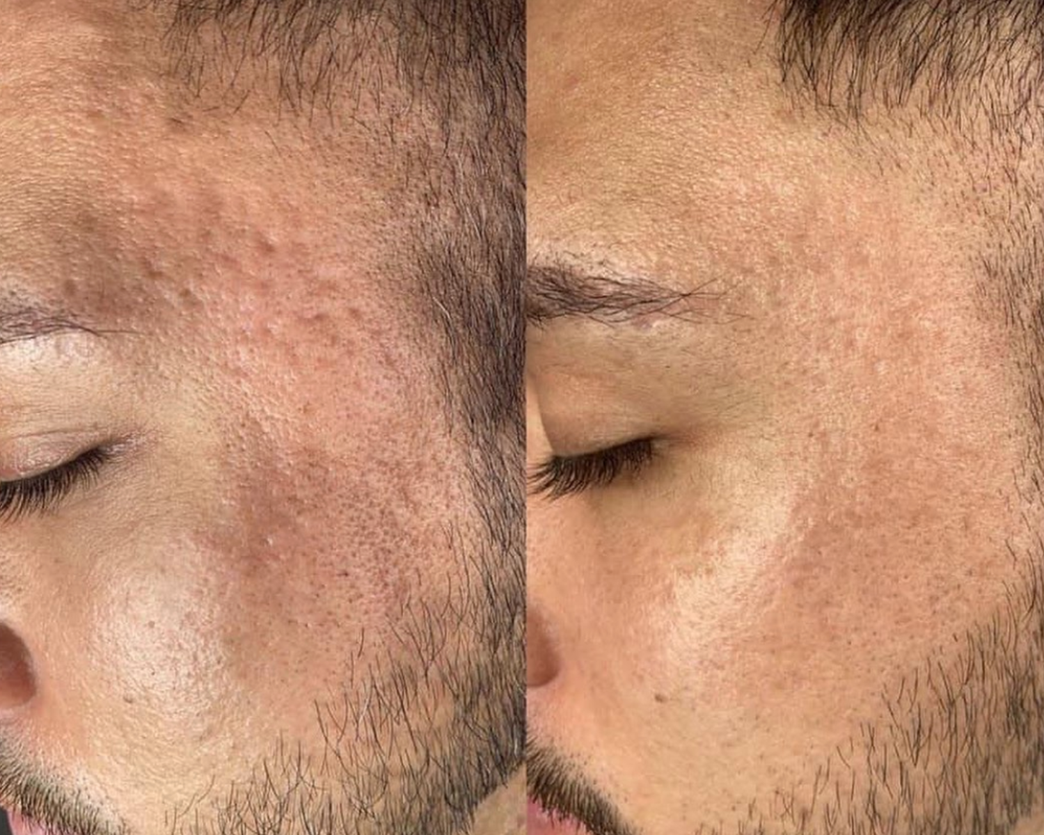 ProCell Microneedling